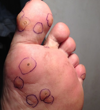 Hình ảnh bệnh nhân bị Hạt cơm (chai chân, mắt cá) do nhiễm Human Papilloma Virus